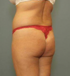 CIRCUMFERENTIAL LIPOSUCTION: Case 87 Before